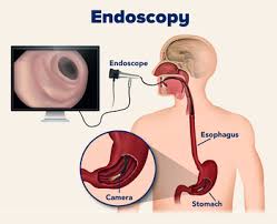 Endoscopy